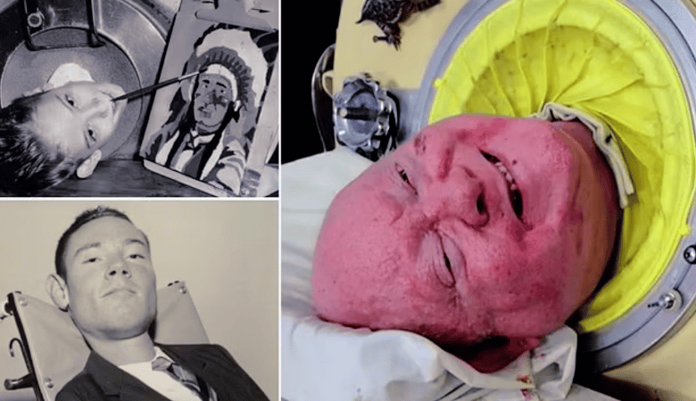 Paul Alexander 'Man in the Iron Lung' Passes Away After 70 Years of Remarkable Life